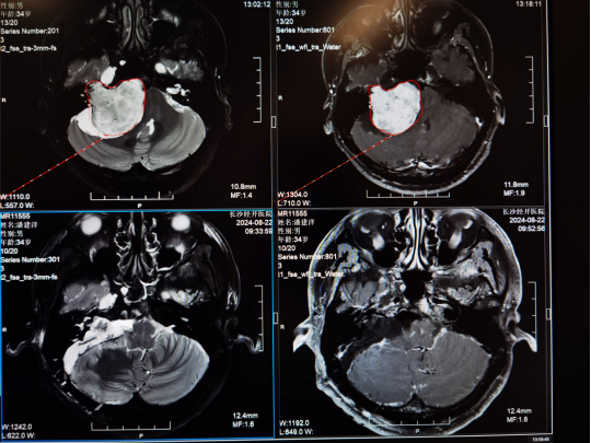 Microsurgery Pada Tumor Dasar Tengkorak