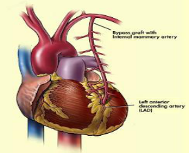 CABG (Coronary Artery Bypass Graft) Tanpa Menghentikan Jantung