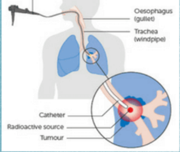 Pengobatan Kanker Radioactive Particle Implantation (Brachytherapy)